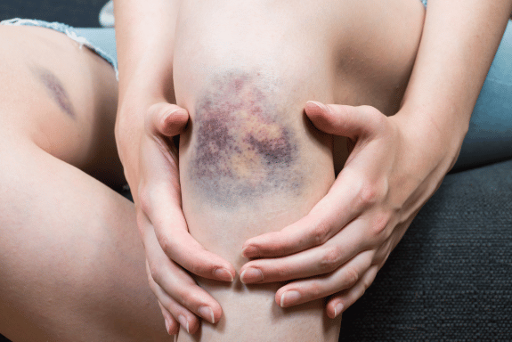 Complex Wound and Pressure Injury Management in Rosebud